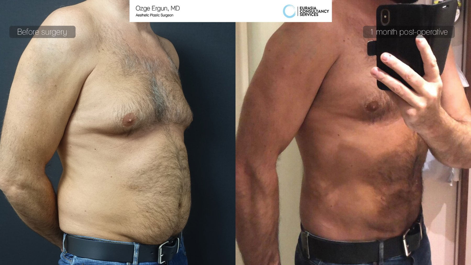 Liposucción Vaser Lipo para reducir volúmen y definir el abdomen masculino  - Dr. Paloma