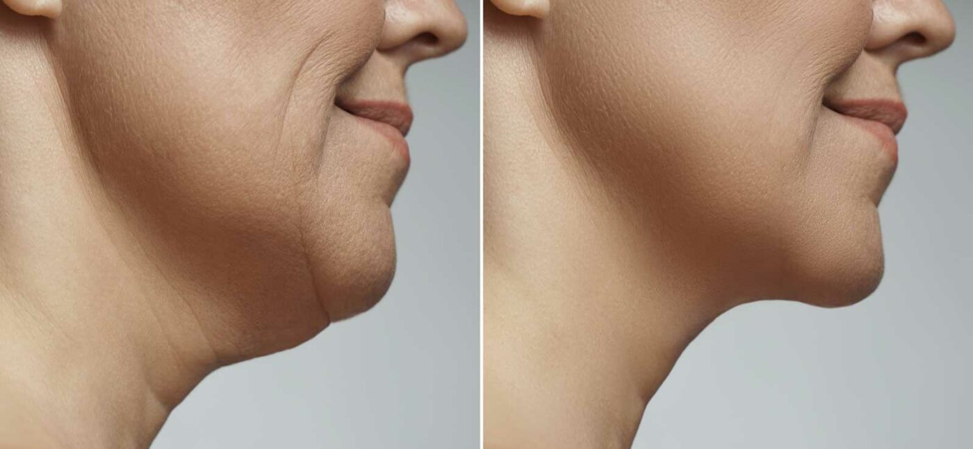Double Chin Surgery